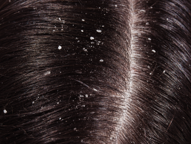 Sanoderm – Sampon <br/> Crema